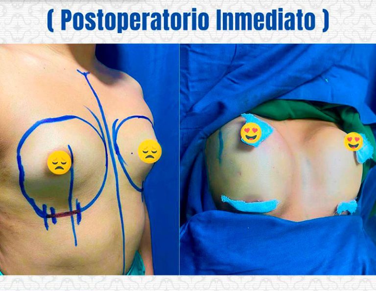 Aumento mamario (350cc) - Postoperatorio inmediato