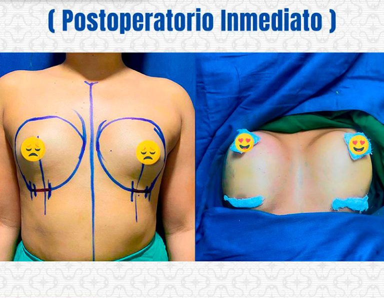 Aumento mamario (350cc) - Postoperatorio inmediato