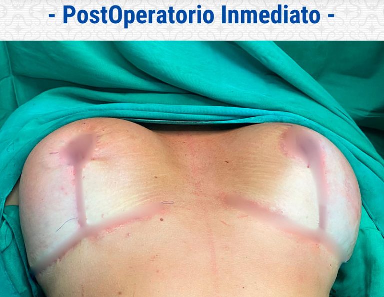 Aumento y levantamiento - Postoperatorio inmediato