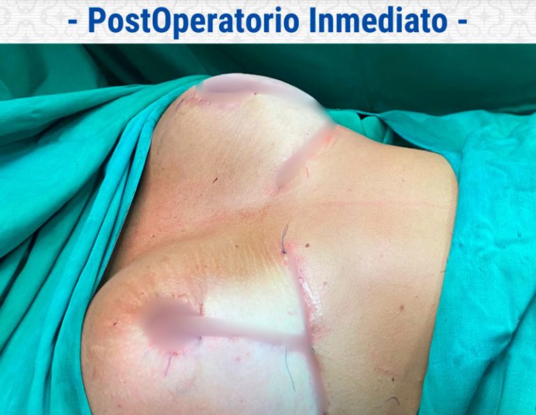 Aumento y levantamiento - Postoperatorio inmediato