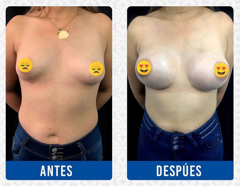 Aumento mamario (antes / después)