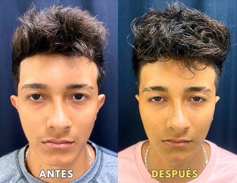 Post-operatorio (40 días)