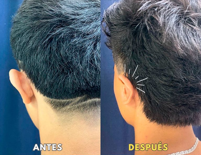 Post-operatorio (40 días)