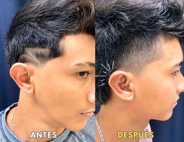 Post-operatorio (40 días)