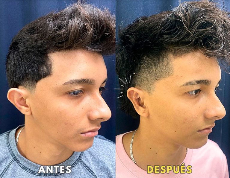 Post-operatorio (40 días)