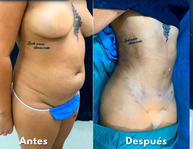 Lipoescultura y aumento de glúteos (Post-operatorio inmediato)
