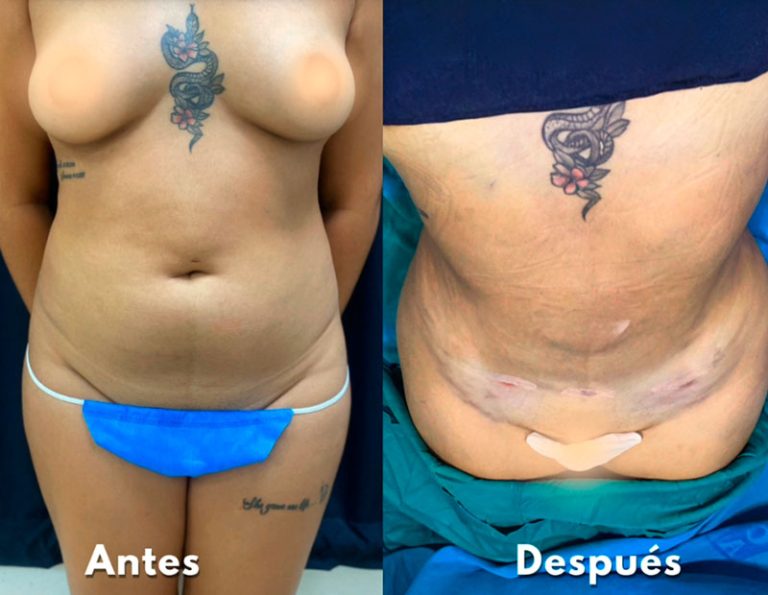 Lipoescultura y aumento de glúteos (Post-operatorio inmediato)