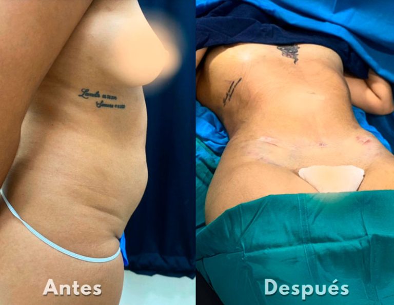 Lipoescultura y aumento de glúteos (Post-operatorio inmediato)