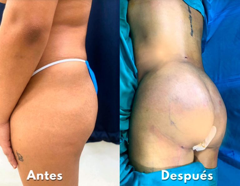 Lipoescultura y aumento de glúteos (Post-operatorio inmediato)