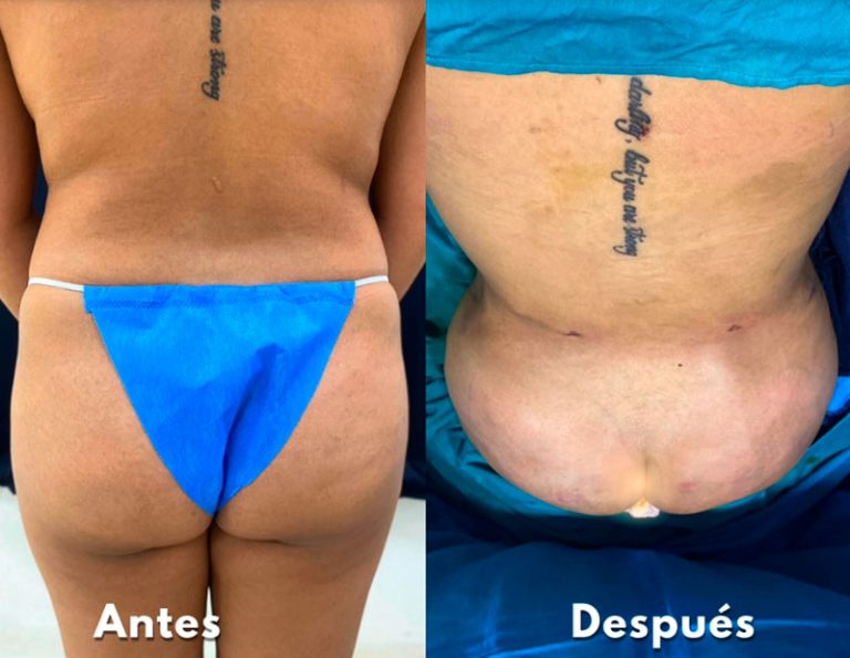 Lipoescultura y aumento de glúteos (Post-operatorio inmediato)