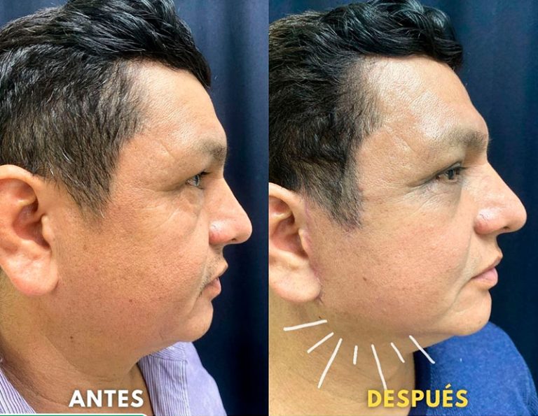 Post-operatorio (45 días)