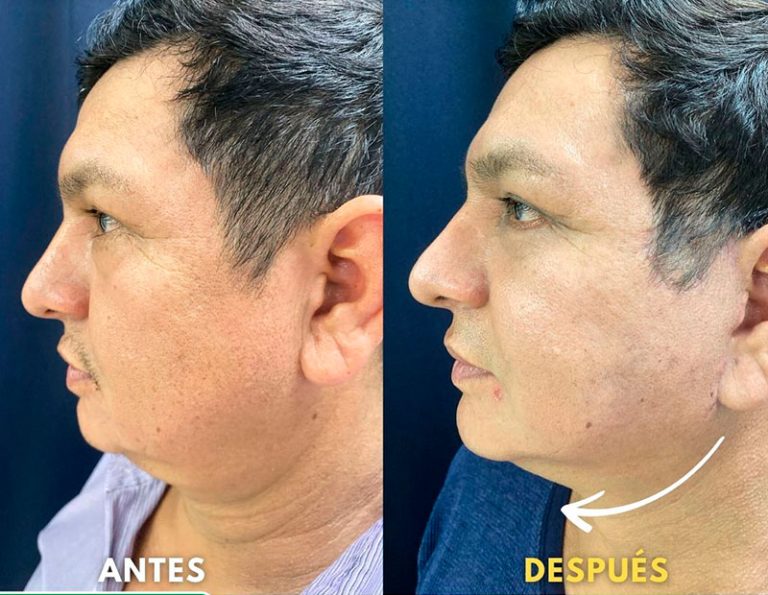 Post-operatorio (45 días)