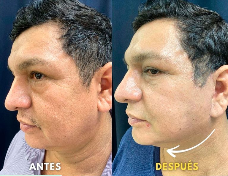 Post-operatorio (45 días)