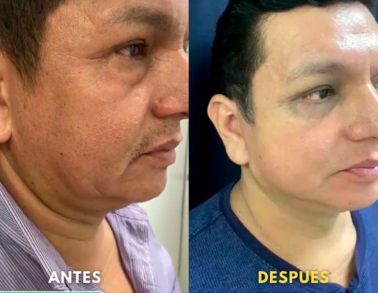 Post-operatorio (45 días)