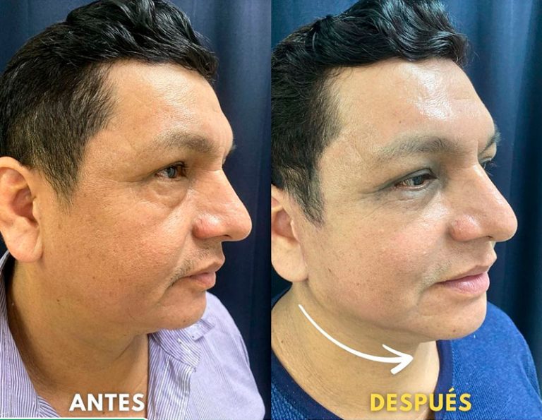 Post-operatorio (45 días)