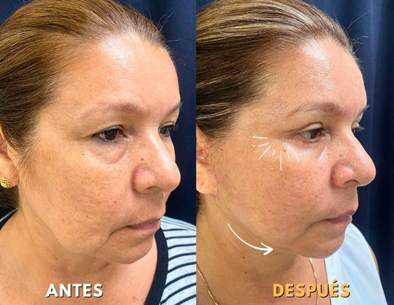 Lifting Facial + Blefaroplastia (2 Meses)