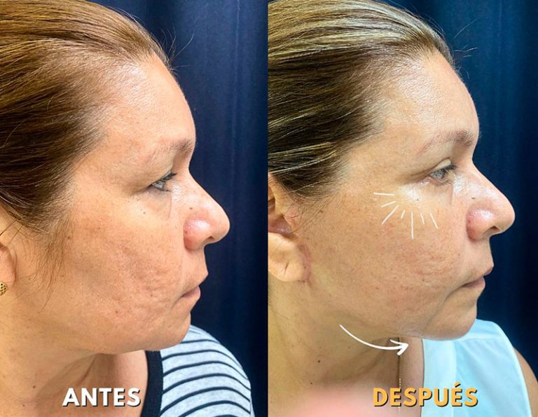 Lifting Facial + Blefaroplastia (2 Meses)