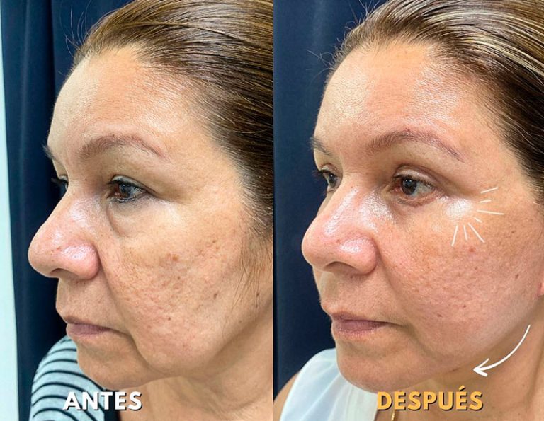 Lifting Facial + Blefaroplastia (2 Meses)