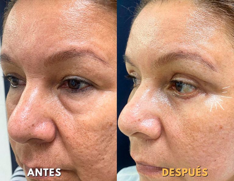 Lifting Facial + Blefaroplastia (2 Meses)
