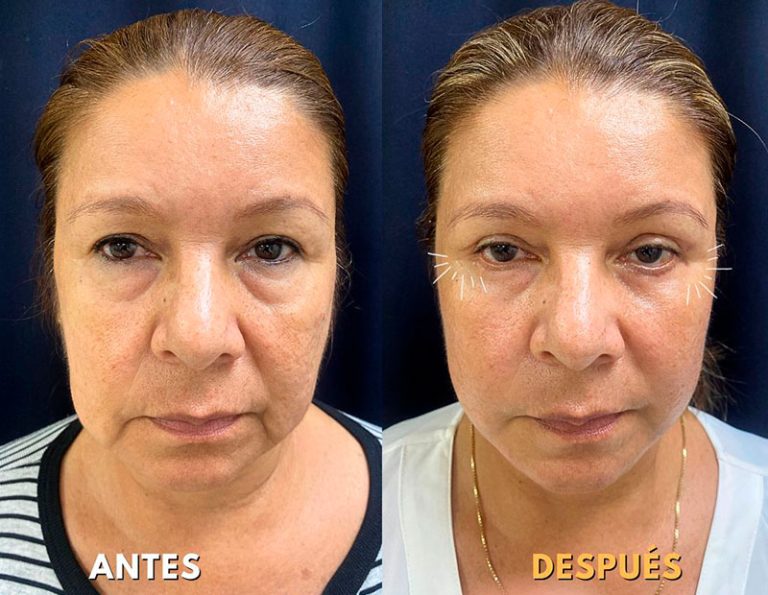 Lifting Facial + Blefaroplastia (2 Meses)