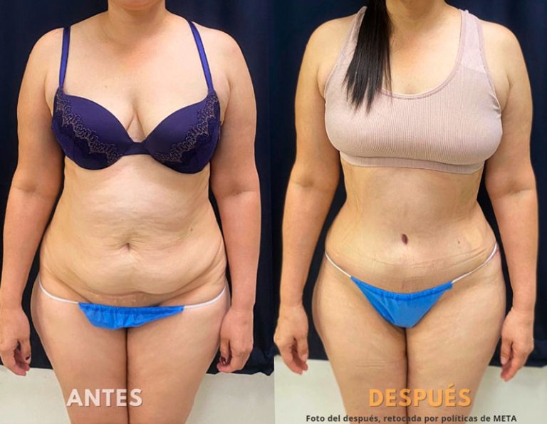 Abdominoplastia (40 días)