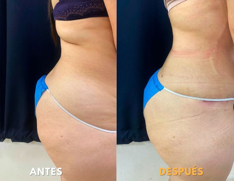 Abdominoplastia (40 días)