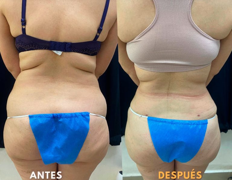Abdominoplastia (40 días)