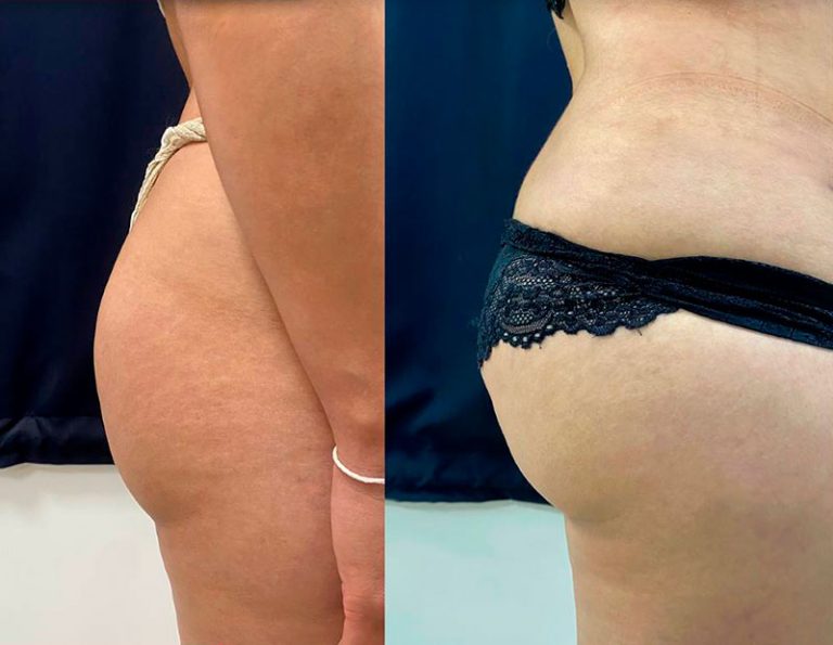 Aumento de glúteos (3 meses)