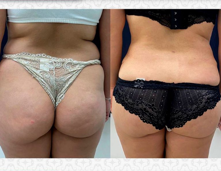 Aumento de glúteos (3 meses)