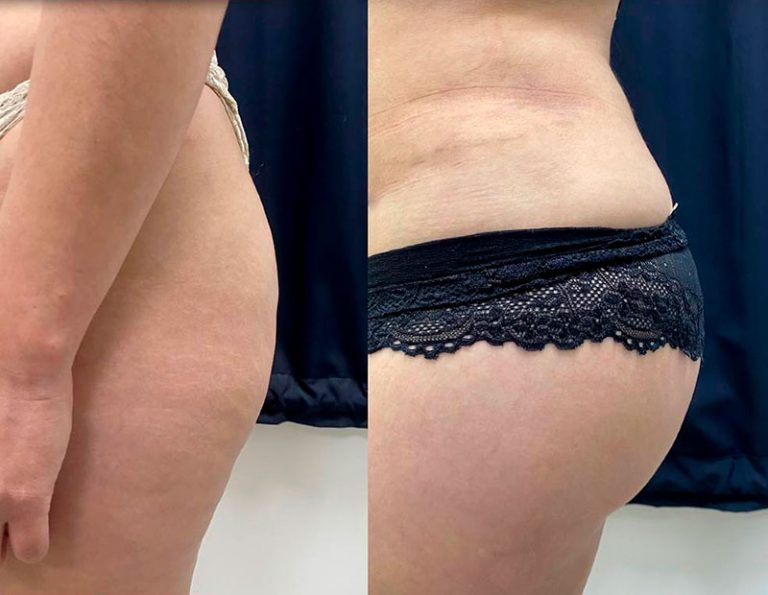 Aumento de glúteos (3 meses)