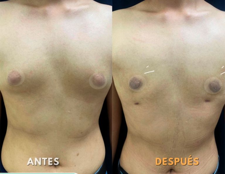 Mastectomia Láser (2 meses)