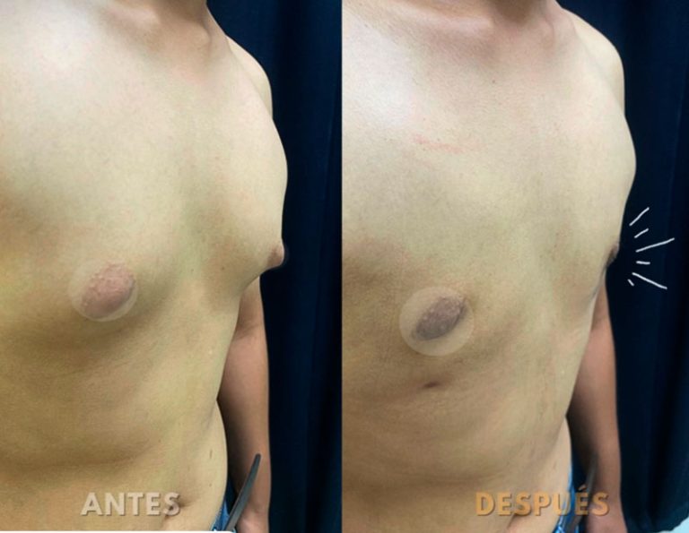 Mastectomia Láser (2 meses)