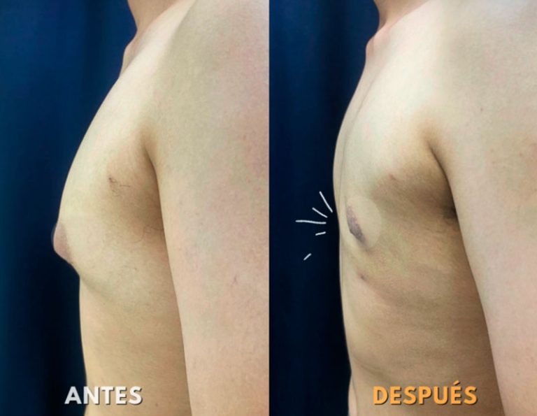 Mastectomia Láser (2 meses)