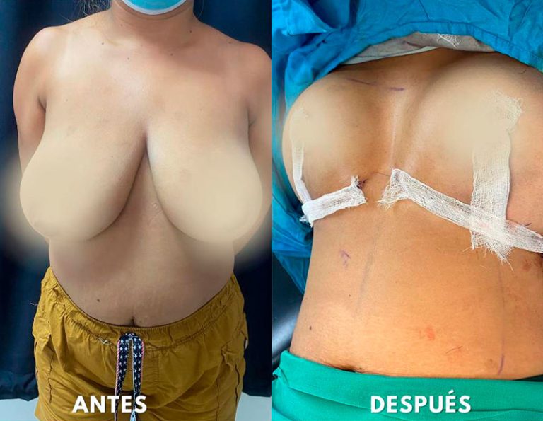 Post-operatorio inmediato