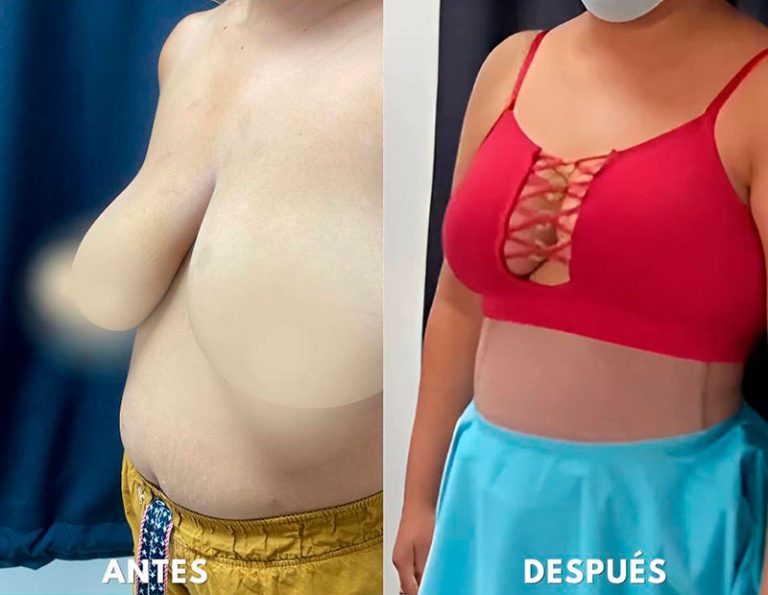 Post-operatorio inmediato