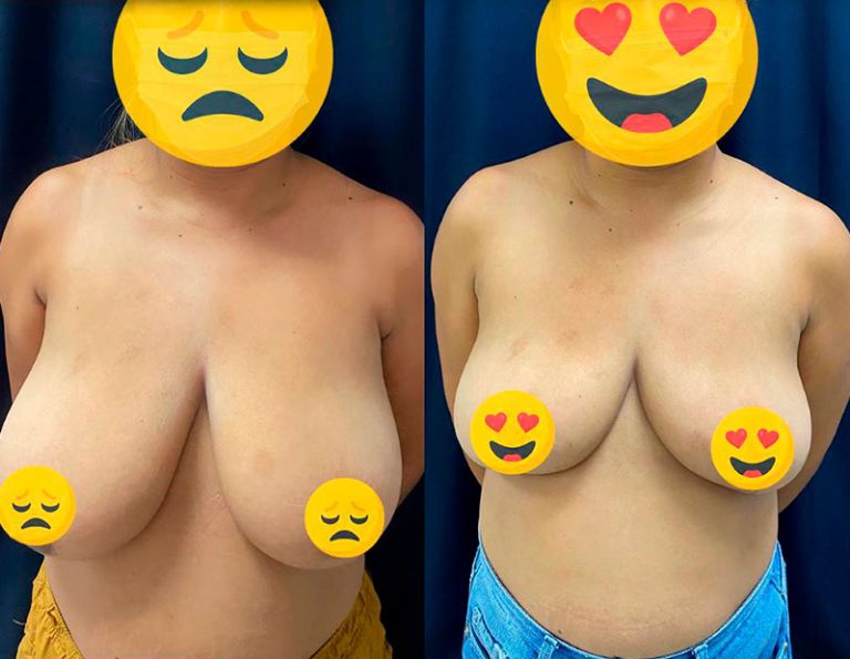 Reducción mamaria (6 meses)