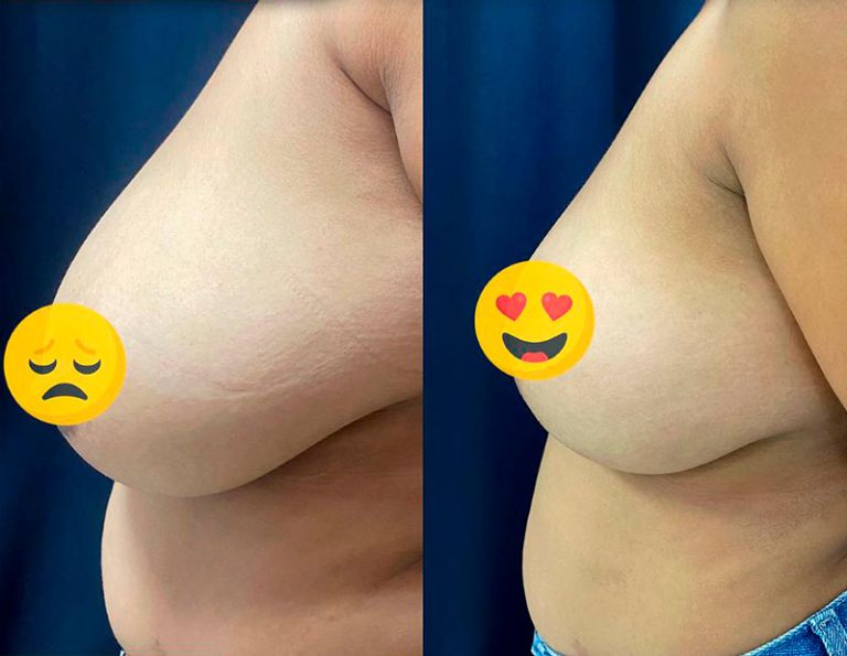 Reducción mamaria (6 meses)