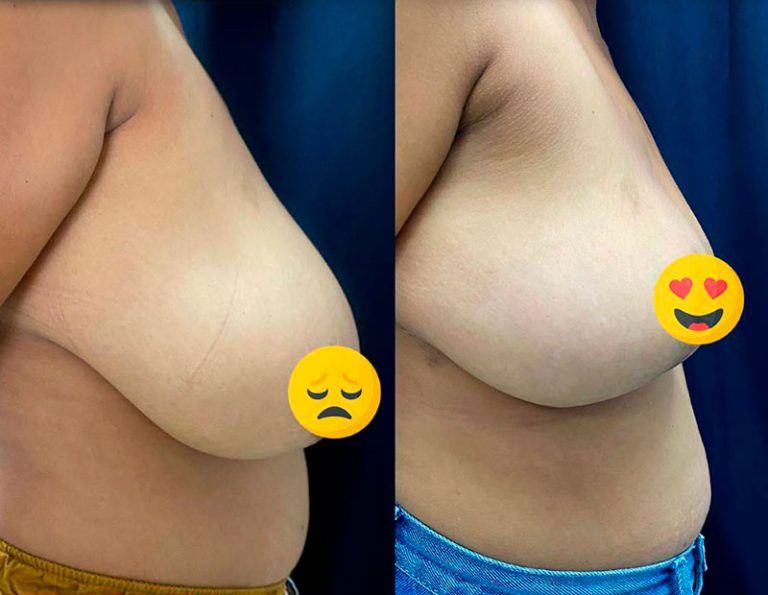 Reducción mamaria (6 meses)
