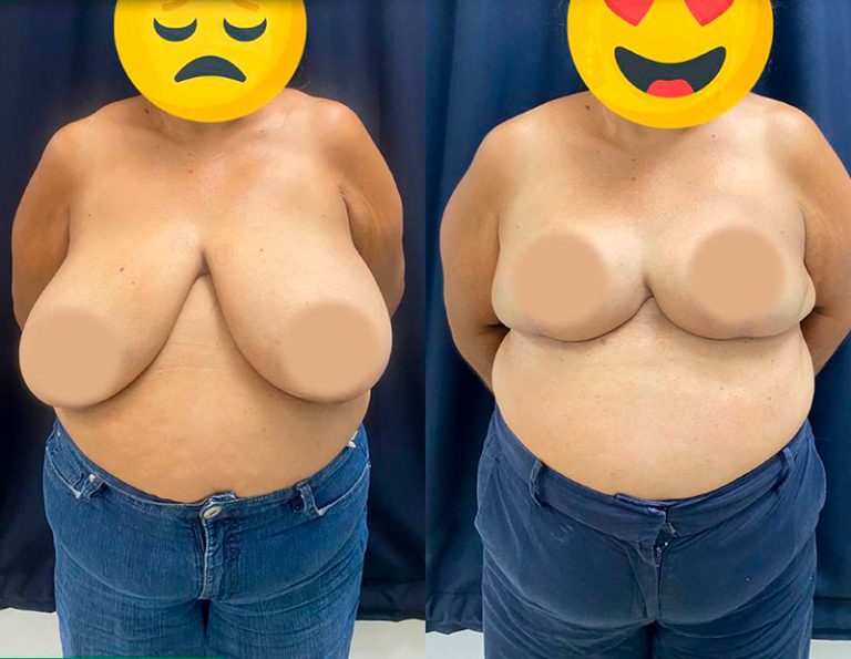 Reducción mamaria (3 meses)