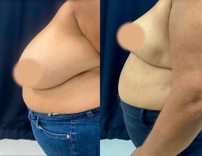 Reducción mamaria (3 meses)