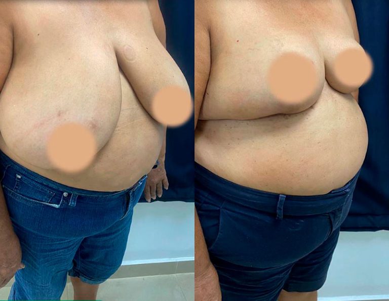 Reducción mamaria (3 meses)