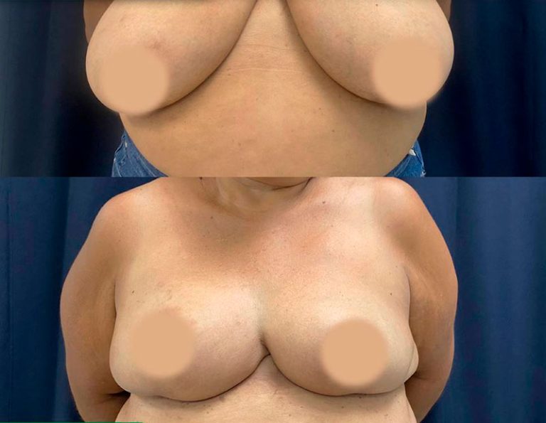 Reducción mamaria (3 meses)