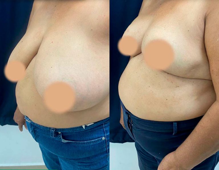 Reducción mamaria (3 meses)