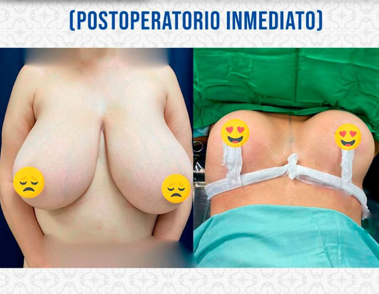 Post-operatorio inmediato