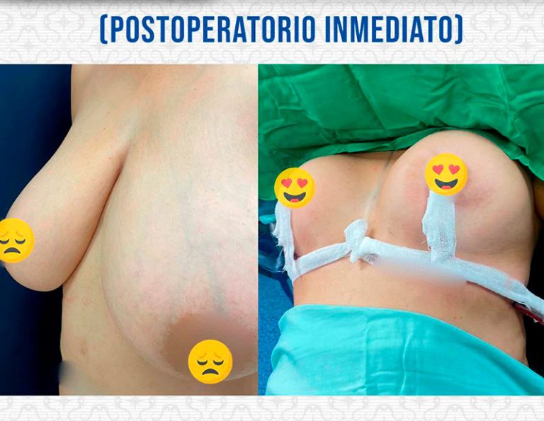 Post-operatorio inmediato