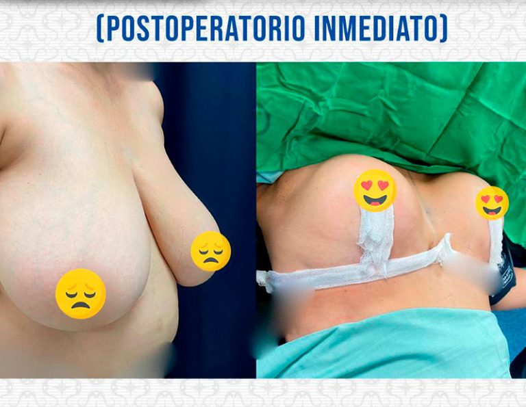 Post-operatorio inmediato