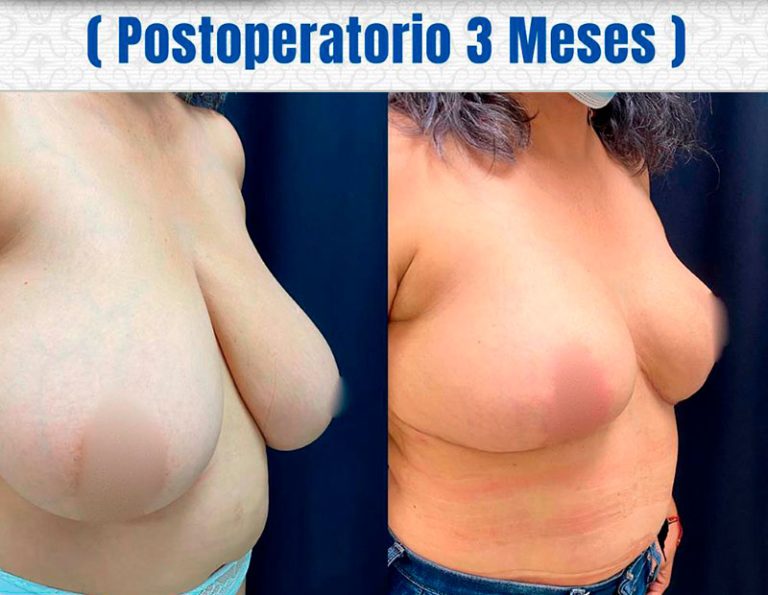 Post-operatorio (3 meses)