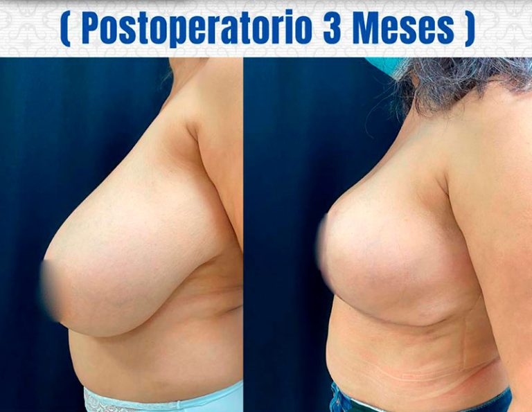 Post-operatorio (3 meses)
