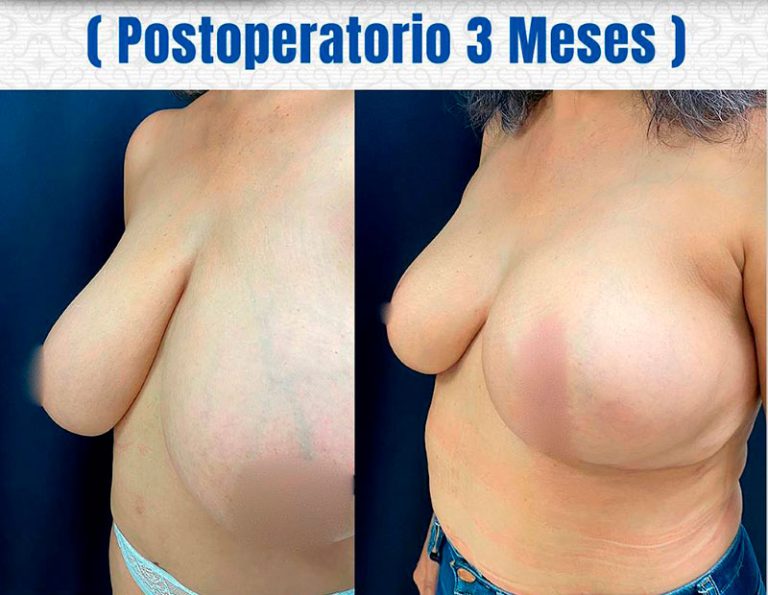 Post-operatorio (3 meses)