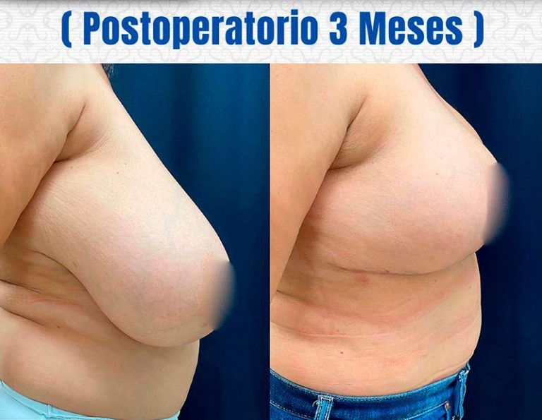 Post-operatorio (3 meses)